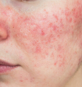 Rosacea Solutions