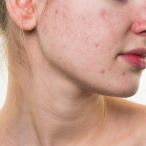 How can I clear my acne fast