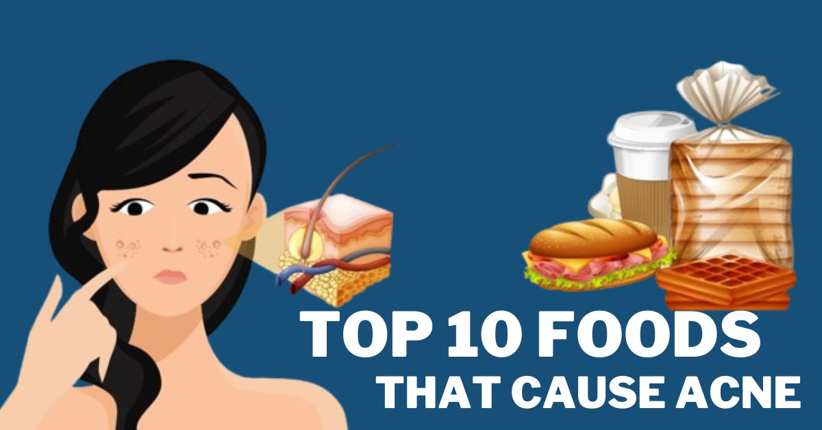 top 10 foods That Cause Acne