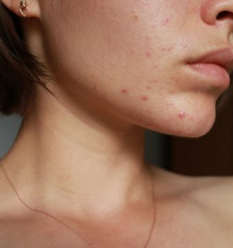 Embarcarse en un viaje de tratamiento del acné puede resultar abrumador